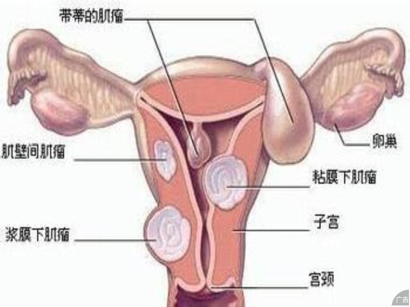 女性卵巢囊肿的症状表现有什么
