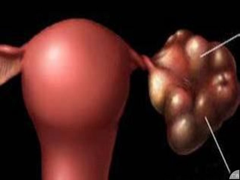 卵巢囊肿的主要检查有什么?