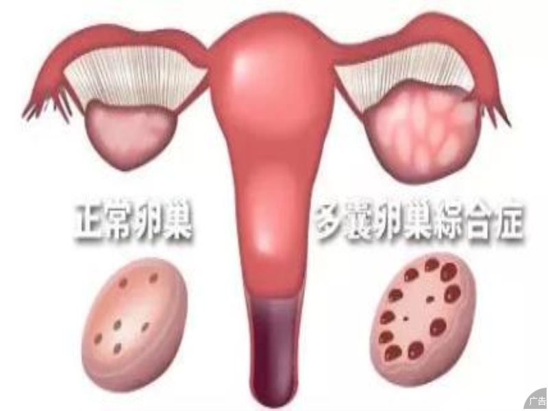 什么原因导致了多囊卵巢综合症的出现