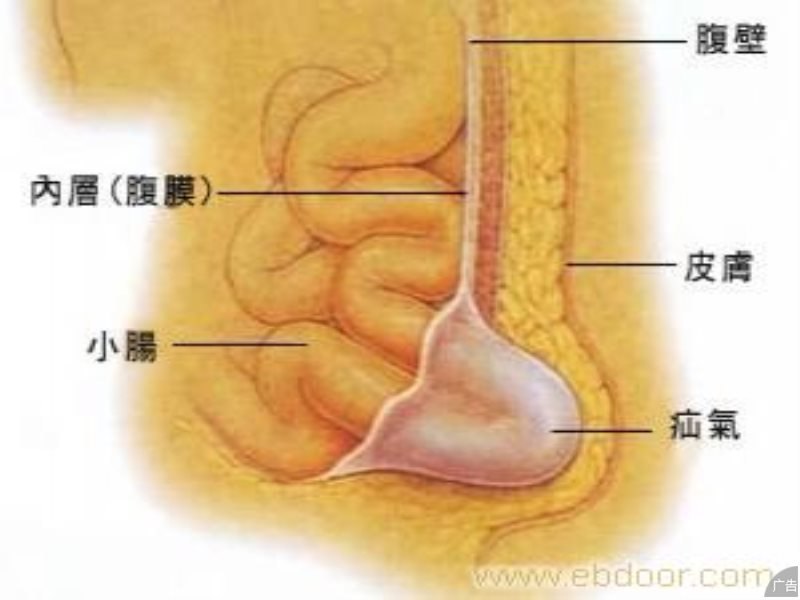 治疗腹股沟疝气的费用要多少?